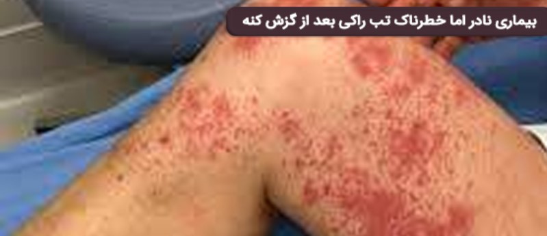 خطرات کنه سگ برای انسان | بیماری تب راکی بعد از گزش کنه سگ در انسان