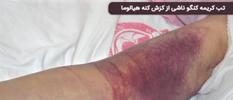 تب کریمه کنگو حاصل گزش کنه سگ در انسان | انتقال بیماری از کنه سگ