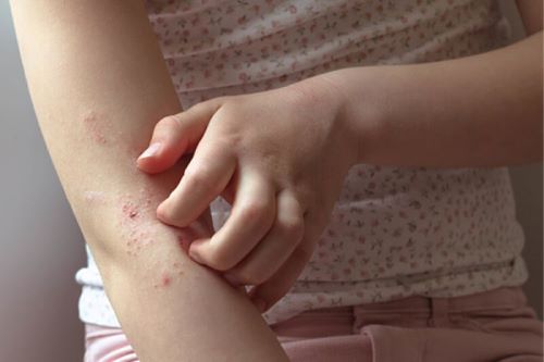 پرنده های خانگی برای ریه ها ضرر دارند | حساسیت به پرنده